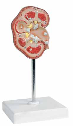 Pathological Model of Renal Calculus